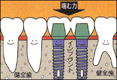 歯が中間で2本抜けた場合の図解（インプラント）