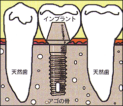 インプラントに支えられた歯の模式図